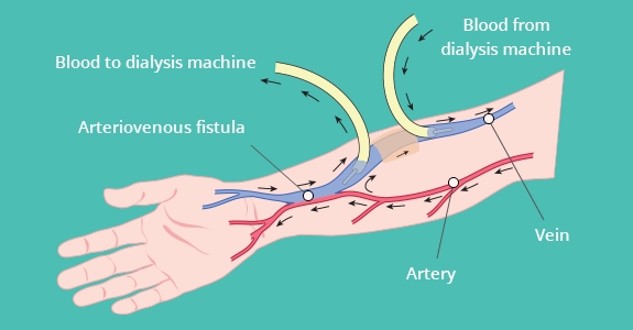 Dialysis Fistula Diagram